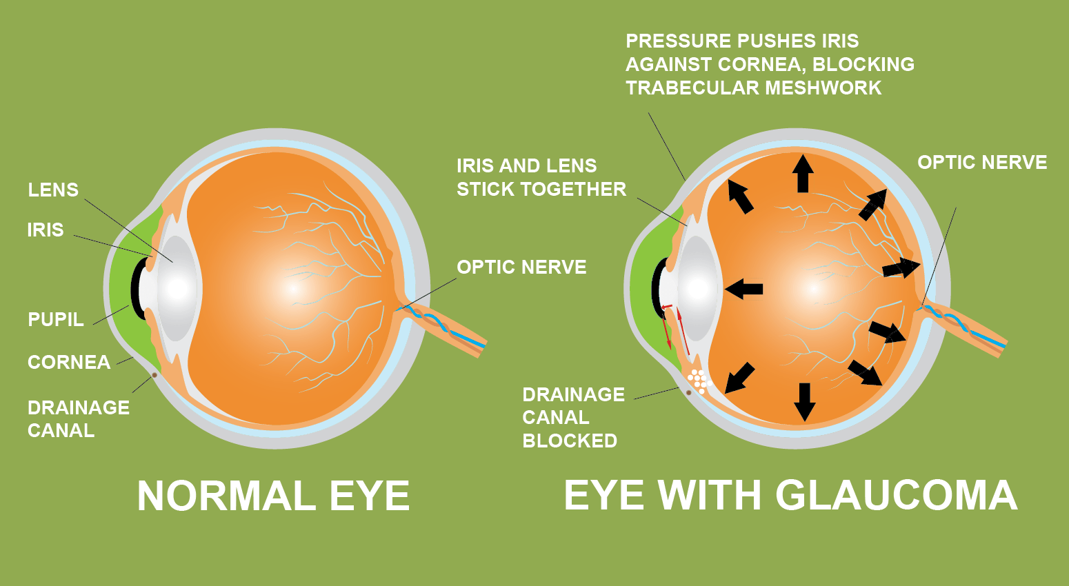Glaucome iris lentille pupille cornée canal de drainage cannabis prévention