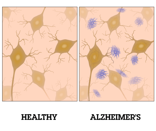 ALZHEIMER MARIJUANA