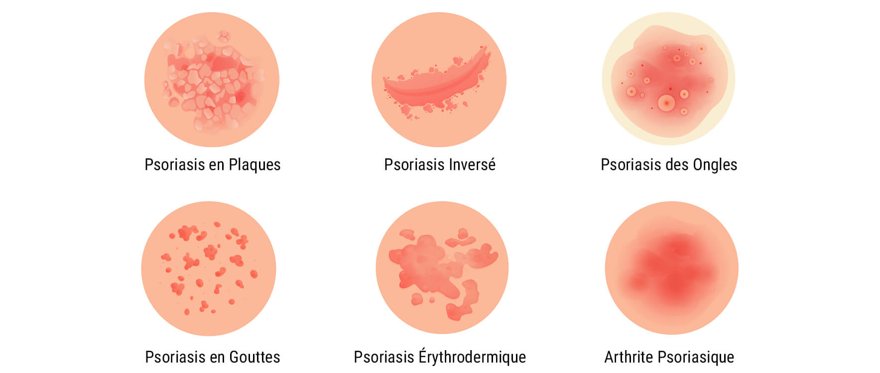 Qu’Est-Ce Que Le Psoriasis ?