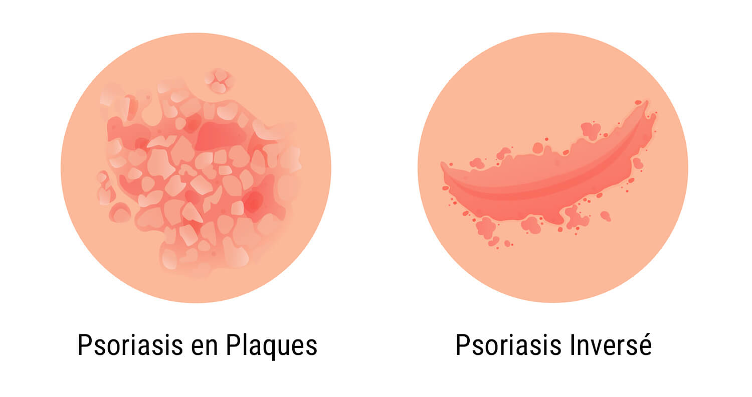 Qu’Est-Ce Que Le Psoriasis ?