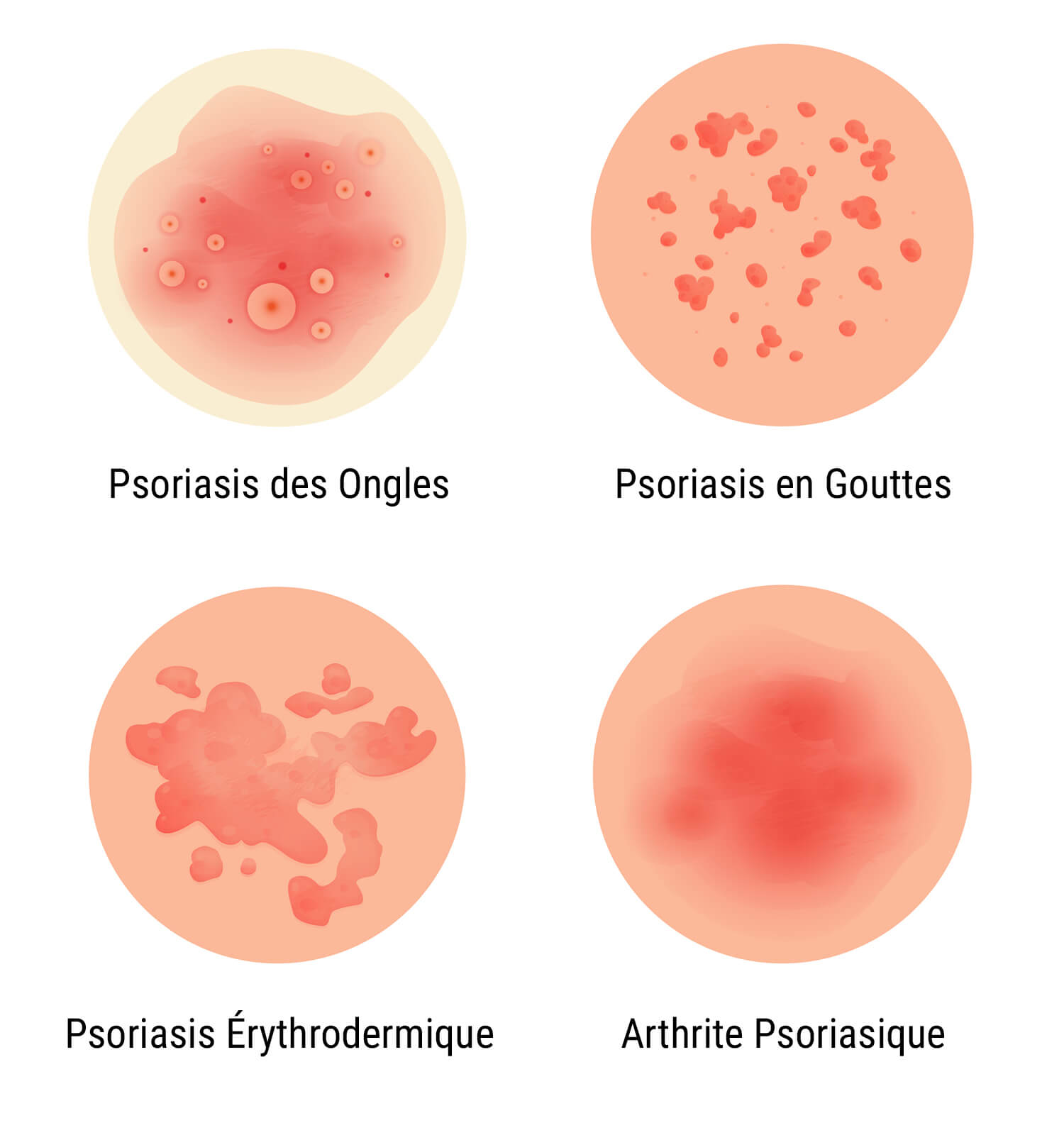 Qu’Est-Ce Que Le Psoriasis ? Qu’Est-Ce Que Le Psoriasis ?