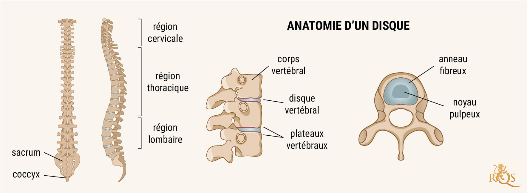 Qu’est-Ce Que La Discopathie Dégénérative ?