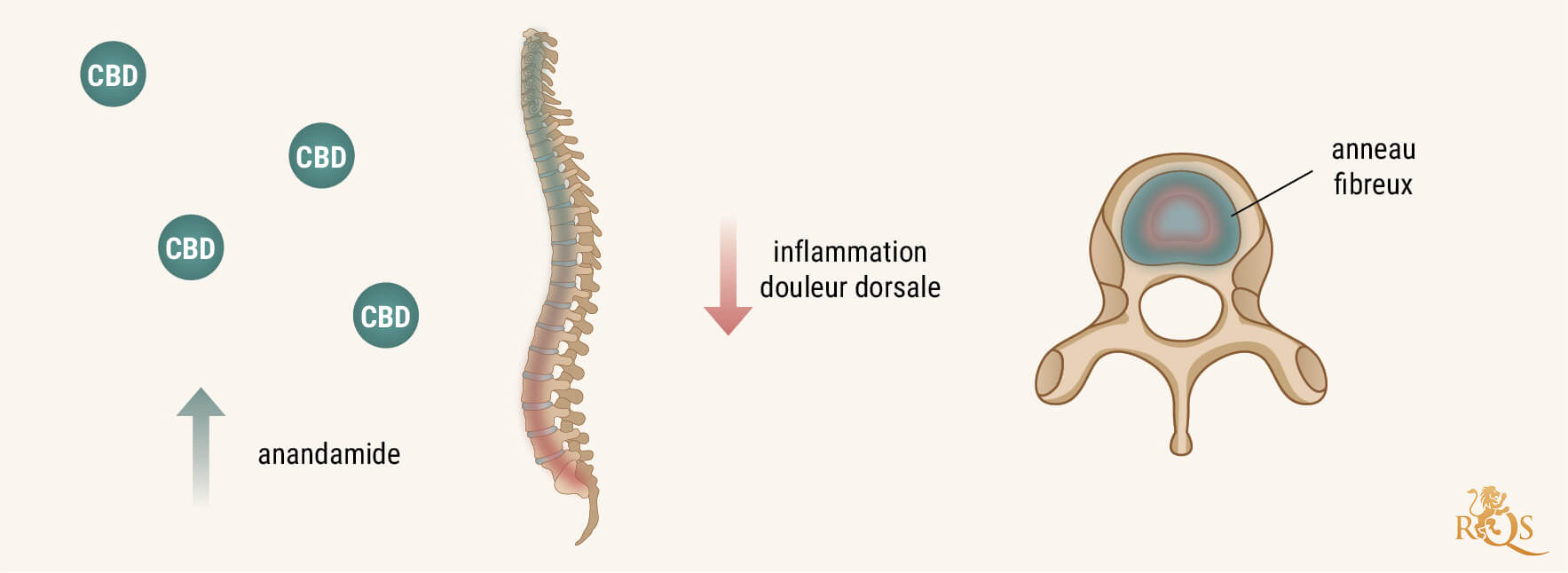 Comment Le CBD Peut-Il Aider Contre La Discopathie Dégénérative ?