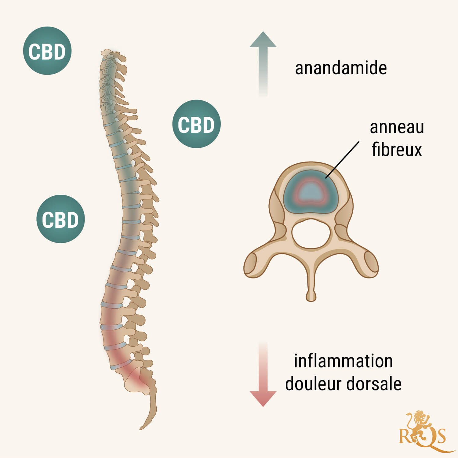 Comment Le CBD Peut-Il Aider Contre La Discopathie Dégénérative ?