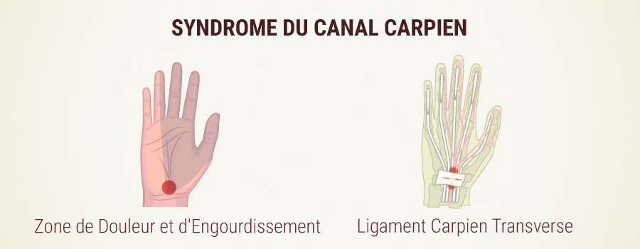 WHAT IS CARPAL TUNNEL SYNDROME?
