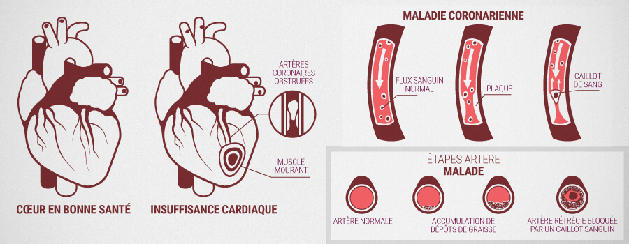 Problèmes Cardiaques Et Comment Le Cbd Peut Aider Problèmes Cardiaques Et Comment Le Cbd Peut Aider