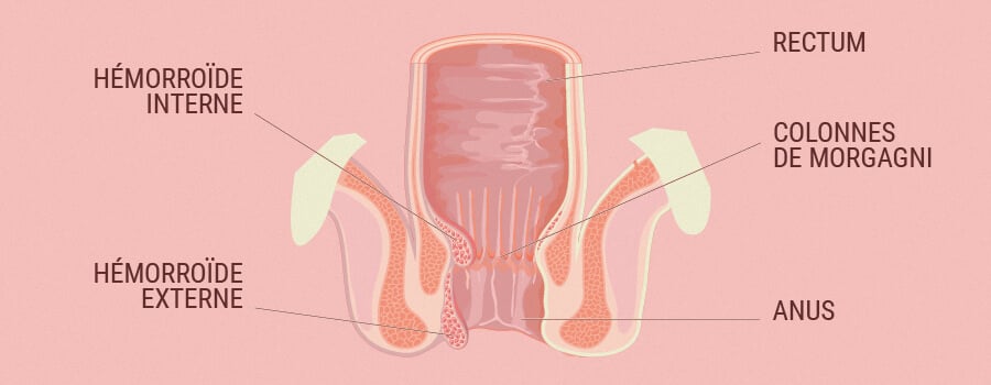 Le lien entre SEC et les hémorroïdes