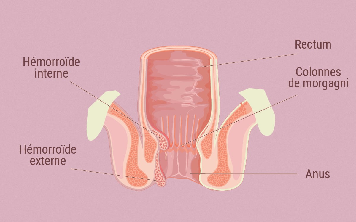 Le lien entre SEC et les hémorroïdes