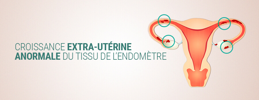 L'Endométriose Et Le Cannabis Chez La Femme L'Endométriose Et Le Cannabis Chez La Femme