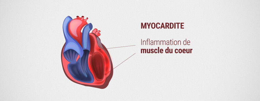 Myocardite Myocardite