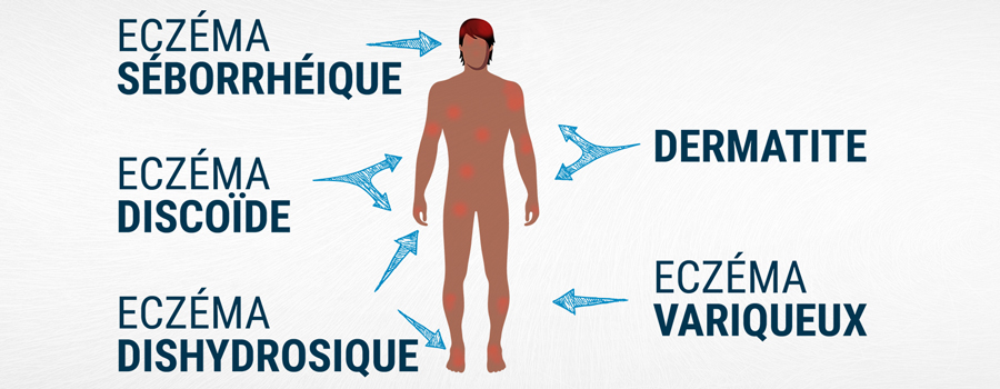 Types d'eczémas traitement avec du cannabis Types d'eczémas traitement avec du cannabis