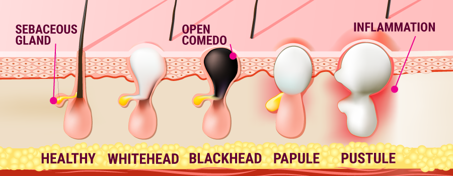 Kinds Of Acne And CBD Kinds Of Acne And CBD