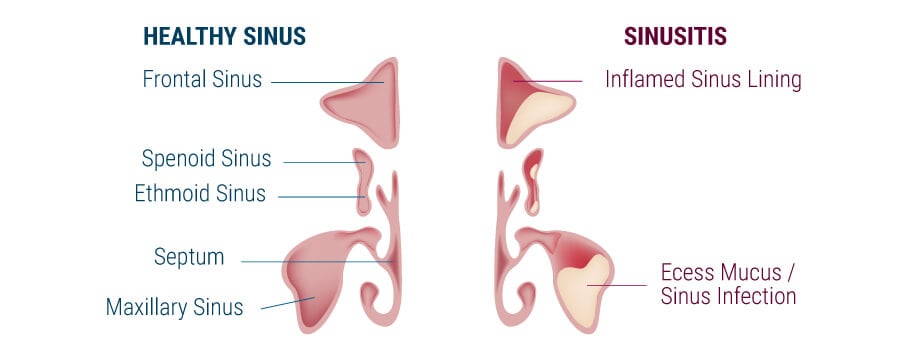 Inflammation Des Sinus