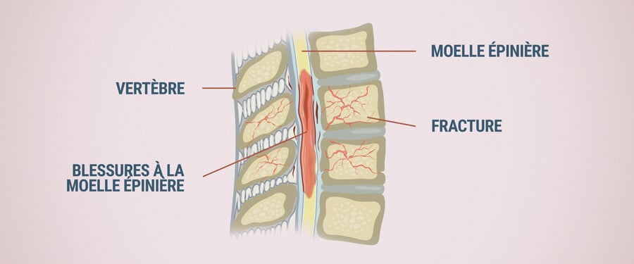 Dommages À La Moelle Épinière