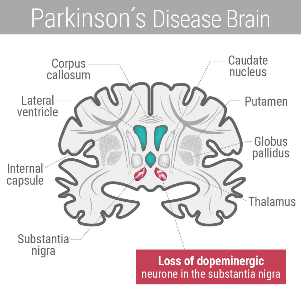 Parkinson's Disease Parkinson's Disease