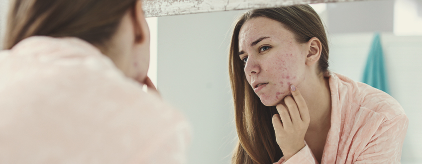 Comment se forme l’acné ?