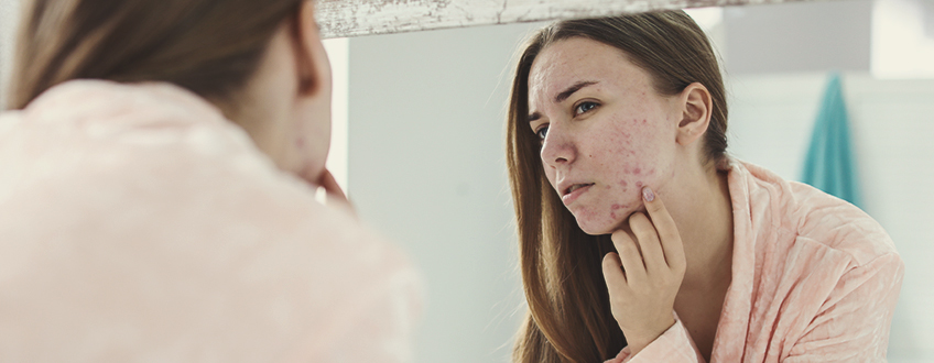 Comment se forme l’acné ? Comment se forme l’acné ?