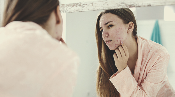 Comment se forme l’acné ?