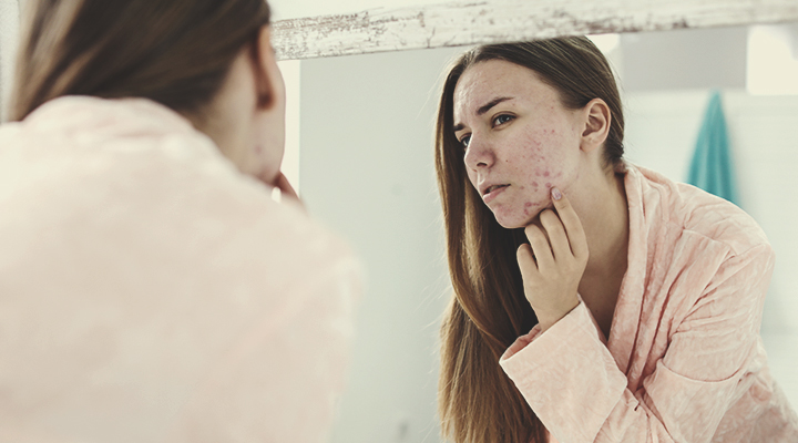 Comment se forme l’acné ? Comment se forme l’acné ?
