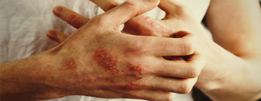 Eczéma et allergies Eczéma et allergies
