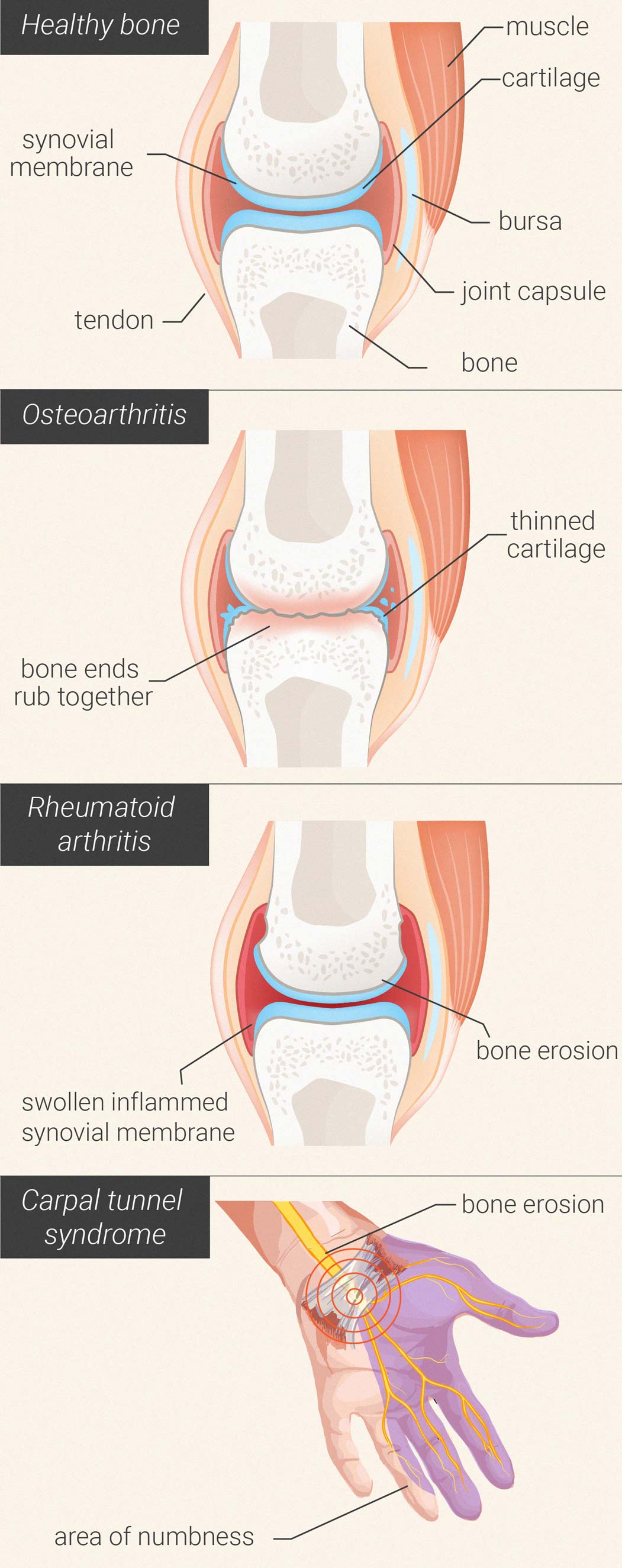 Le cannabis réduit-il douleur et inflammation arthritiques ?