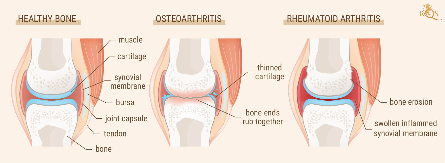 L'arthrite et les rhumatismes sont-ils la même chose ? L'arthrite et les rhumatismes sont-ils la même chose ?