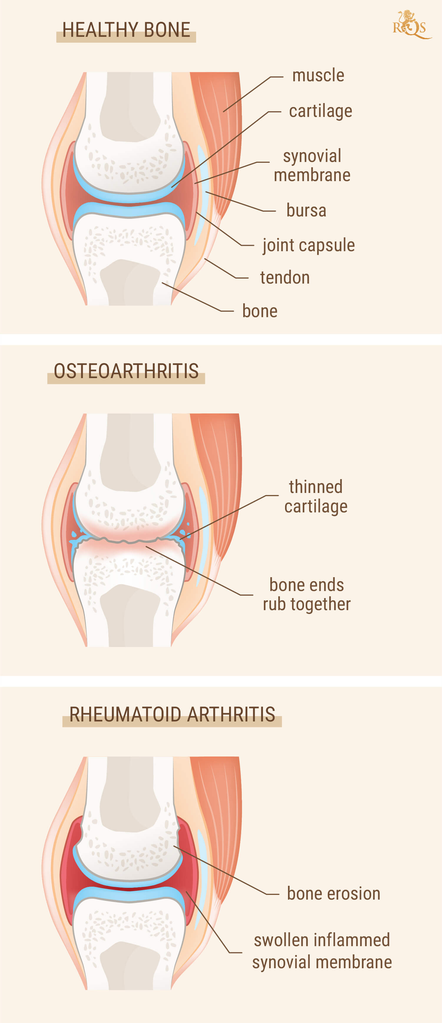 L'arthrite et les rhumatismes sont-ils la même chose ? L'arthrite et les rhumatismes sont-ils la même chose ?