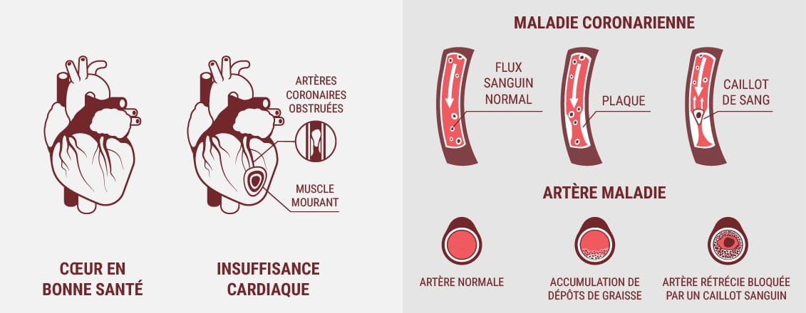 Les maladies cardiovasculaires et les maladies cardiaques sont-elles les mêmes ?