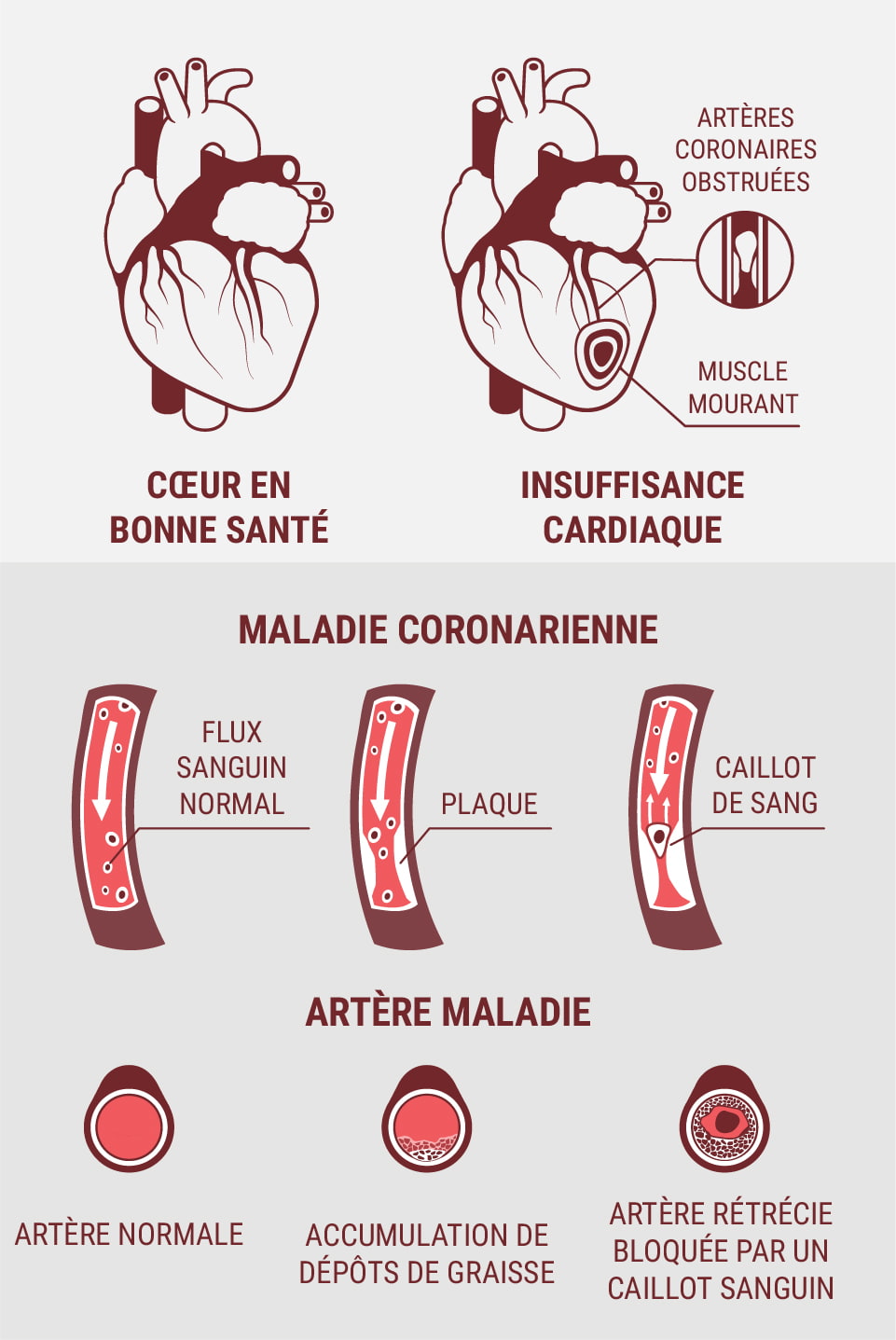 Les maladies cardiovasculaires et les maladies cardiaques sont-elles les mêmes ?