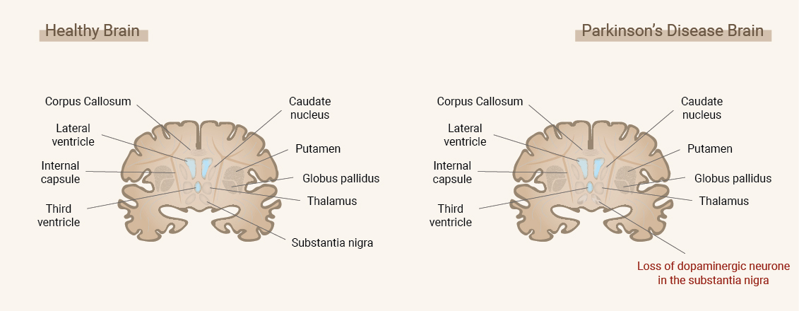 Qu’est-ce que la maladie de Parkinson ? Qu’est-ce que la maladie de Parkinson ?