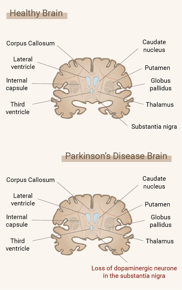 Qu’est-ce que la maladie de Parkinson ?