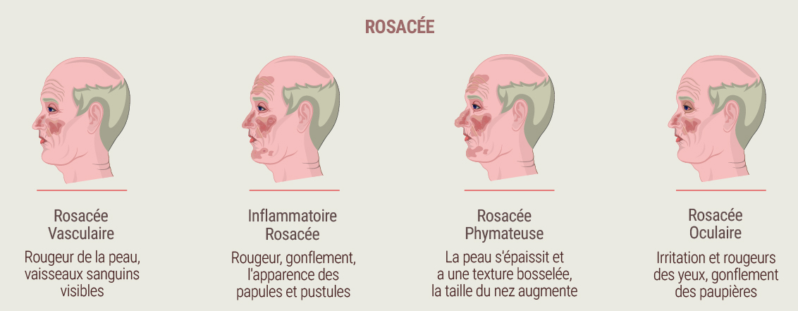 Qu’est-ce que la rosacée ? Qu’est-ce que la rosacée ?