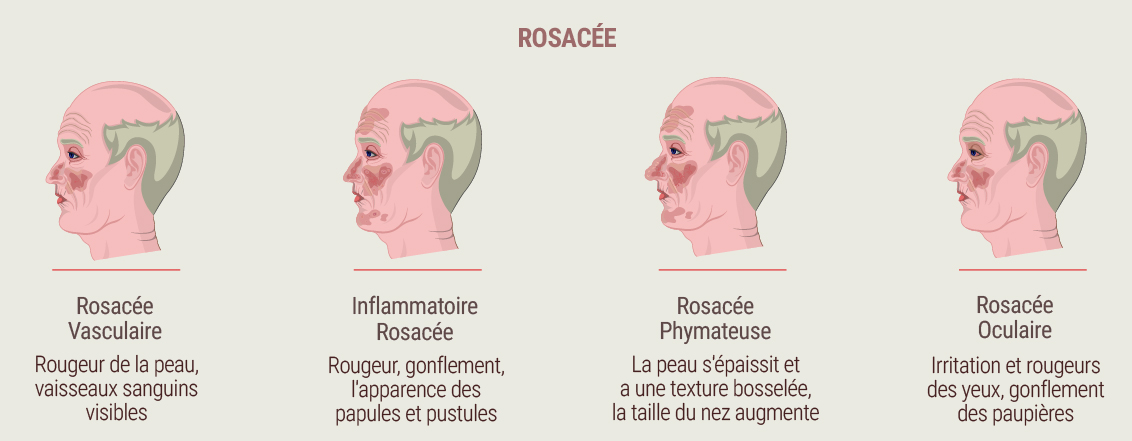 Qu’est-ce que la rosacée ?