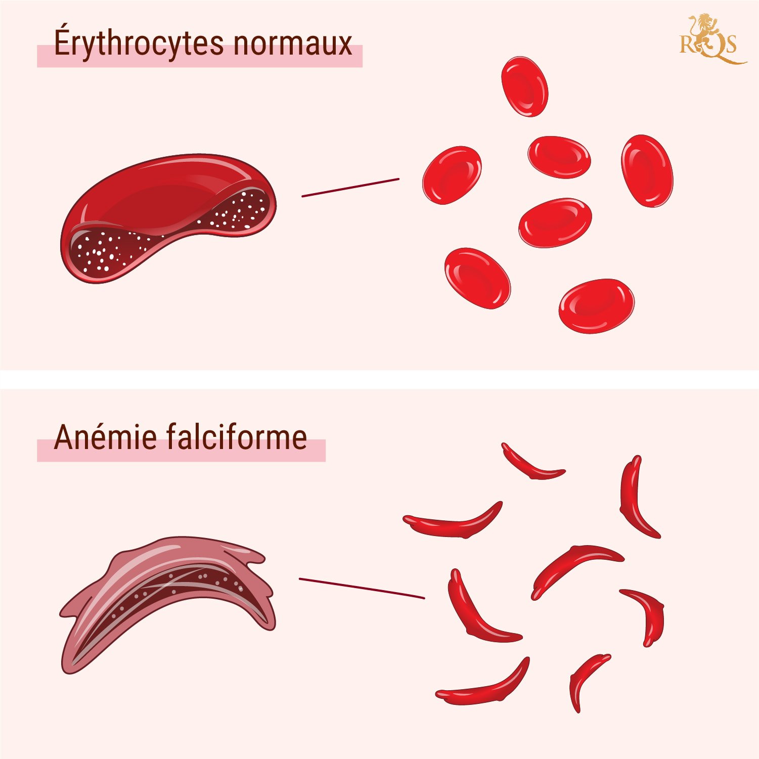 Qu’est-ce que la drépanocytose