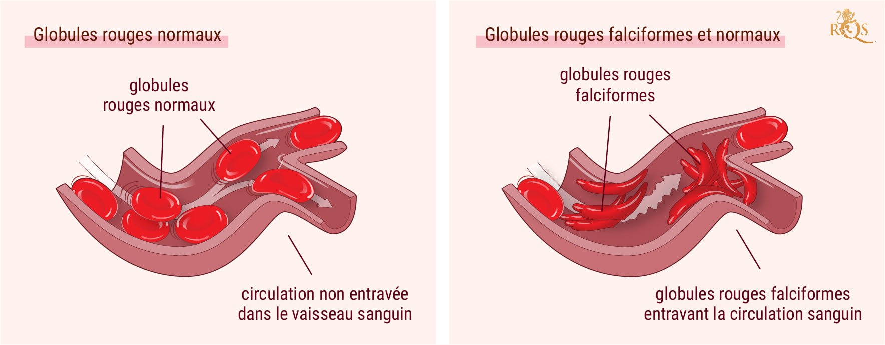 Cannabis et symptômes de la drépanocytose