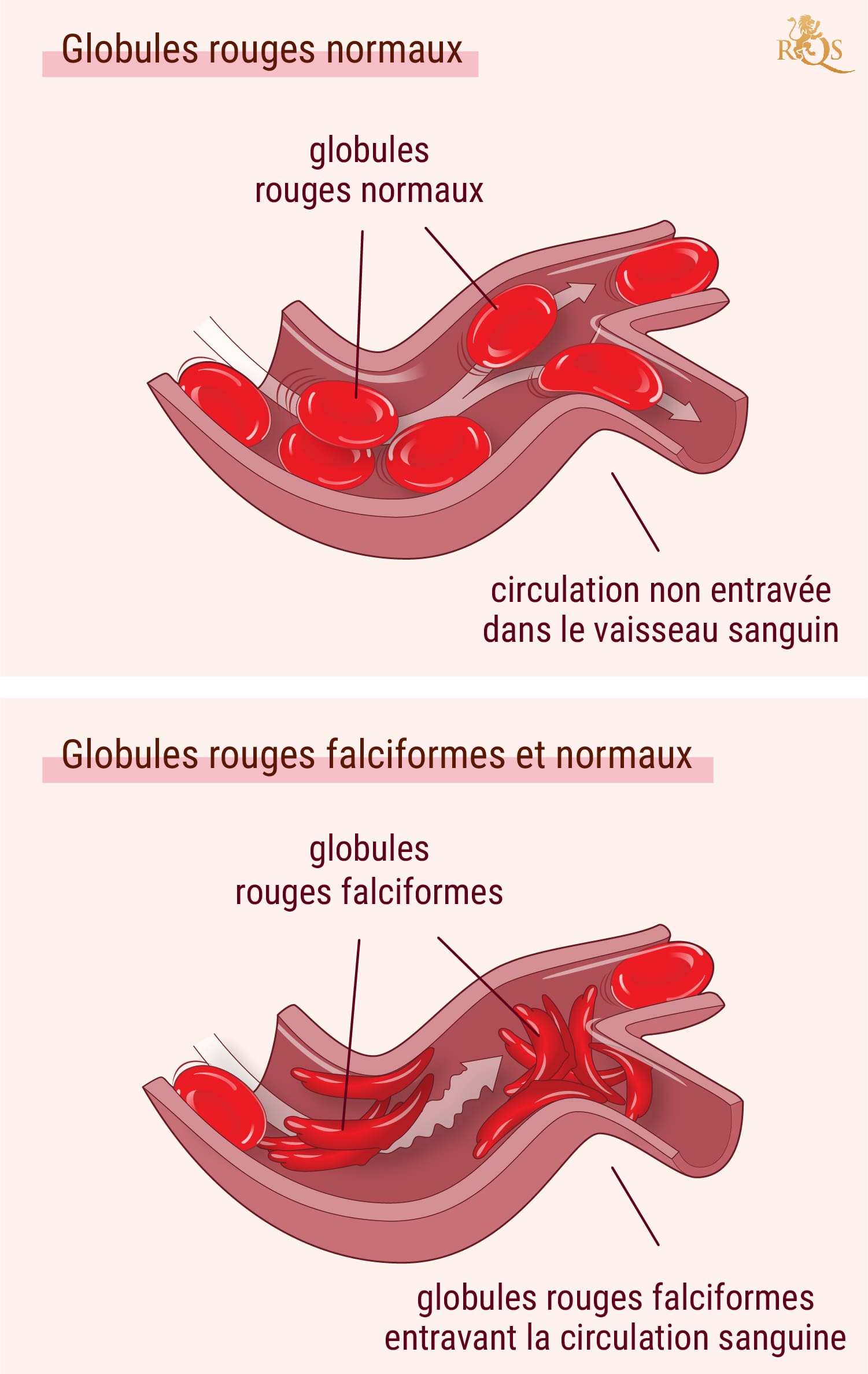 Cannabis et symptômes de la drépanocytose